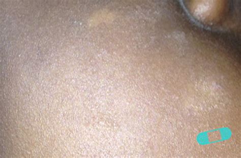 It tells you what it is, what causes it, what can be done about. Online Dermatology - Pityriasis Alba