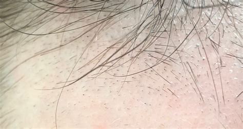 what is the diagnosis trichotillomania vs alopecia areata — donovan hair clinic