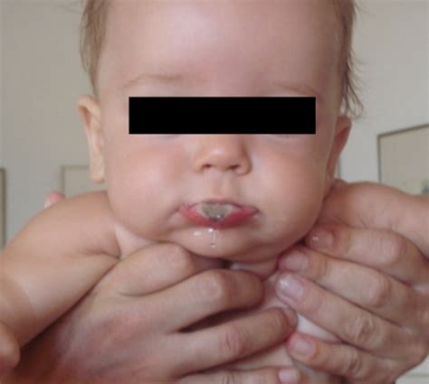 Oral Ulceration In A Child With Severe Congenital Neutr Open I