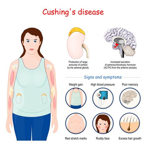 Quels Sont Les Causes Et Traitements Du Syndrome De Cushing Esculape