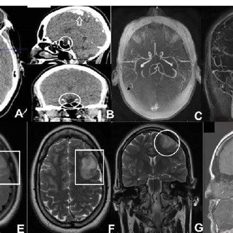 Ab Ct Of The Brain With Contrast And Reconstruction In Sagittal And