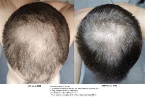 10 Months Hair Loss Treatment Progress Finasteride Dutasteride And