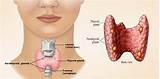 Overactive Thyroid Home Remedies