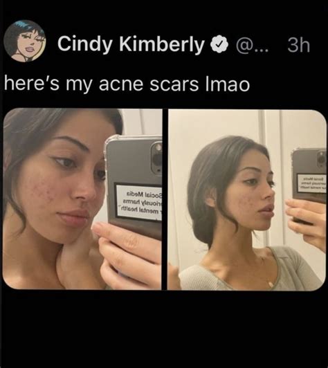 Cindy Kimberly Beauty Myth Male Beauty Acne Skin Acne Scars