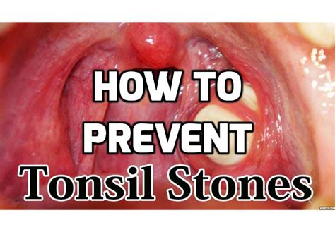 What Are The Best Ways To Really Prevent Tonsil Stones