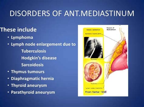 Anatomy Of Mediastinum And Its Disorders