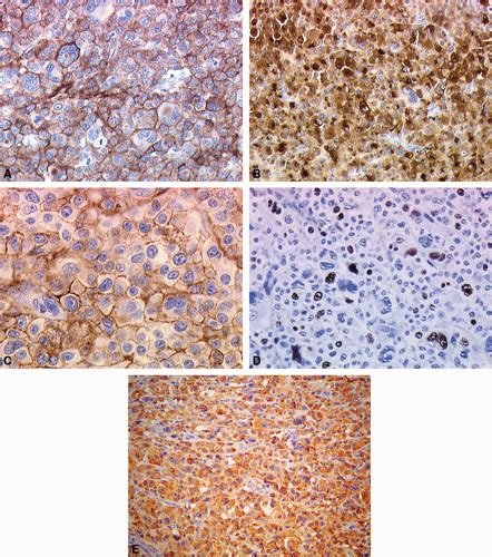 Cutaneous Plasma Cell Neoplasms Basicmedical Key