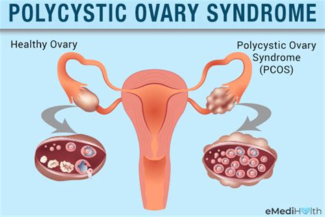 Understanding Pcos Causes Symptoms And Treatment