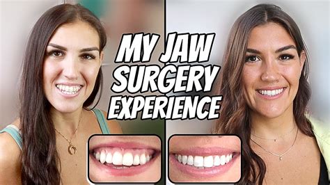 My Double Jaw Surgery Experience 2022 Before And After 5 Months Post