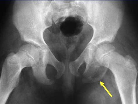 Ischium Pelvic Bone Anatomy