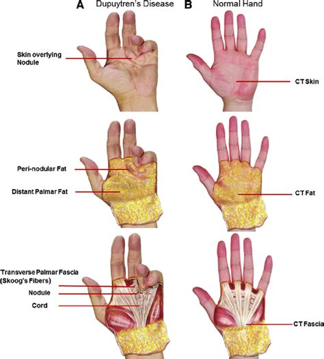 Photograph Of Dupuytrens Contracture Compared With Normal Hand A Download Scientific