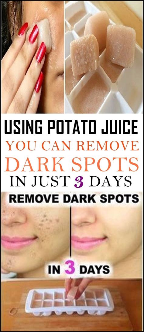 Using Potato Juice You Can Remove Dark Spots In Just 3 Days Remove