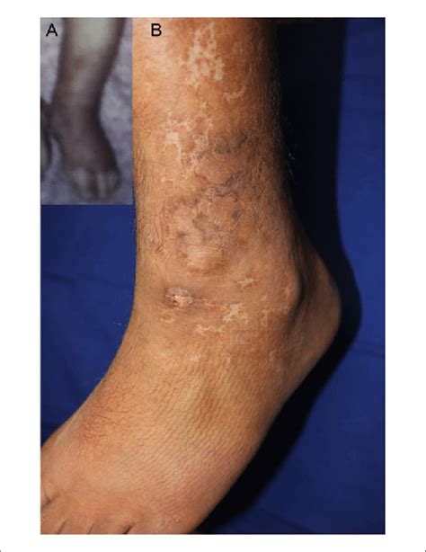 A Photograph Brought By The Patients Mother Showing The Hemangioma