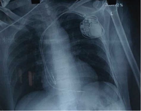 Chest X Ray Showing Dual Chamber Permanent Pacemaker Pulse Generator