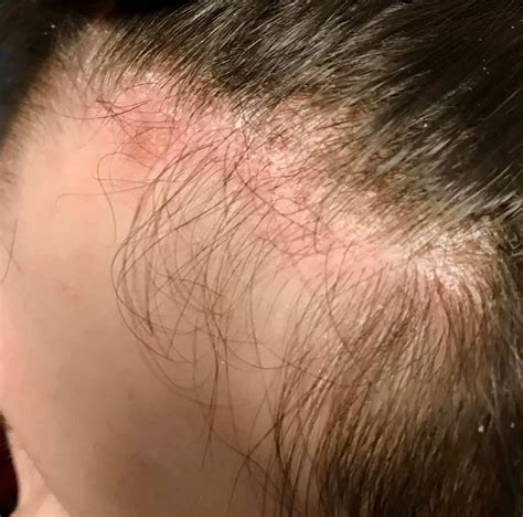 List 94 Pictures Show Pictures Of Scalp Psoriasis Stunning