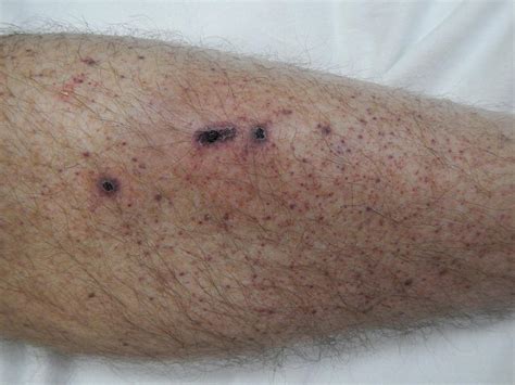 Petechiae Causes Treatments And Pictures