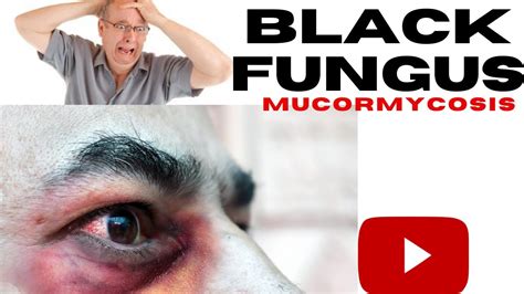 Black Fungus Explained Hindiurdu Blackfungus Thebanyteam