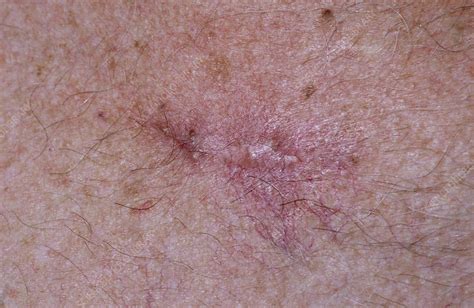 Skin Cancer Stock Image M1310573 Science Photo Library