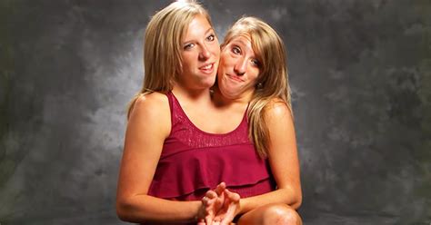 Conjoined Twins Abby And Brittany Indialsa