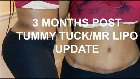 Tummy Tuck 4 Months Post Op Pictures The Meta Pictures
