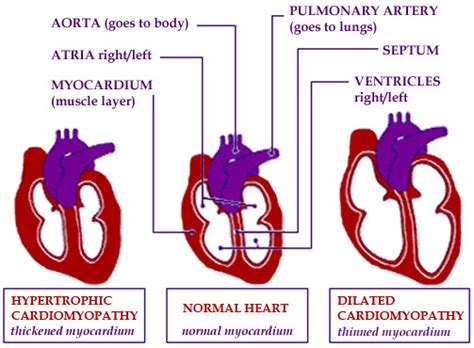 Myocarditis is collection of diseases of infectious, toxic, and autoimmune etiologies characterized by inflammation of the heart. Cardiovascular System - Lorna Pluto Human Pathology