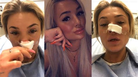 New Years Nightmare Womans Boyfriend Allegedly Bites Her Nose Off