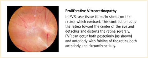 Proliferative Vitreo Retinopathy — Cumberland Valley Retina Consultants