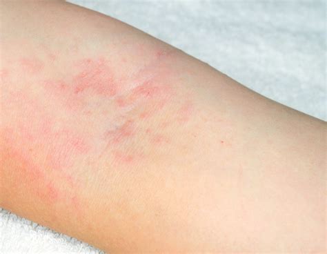 Causes Of Rashes In Adults