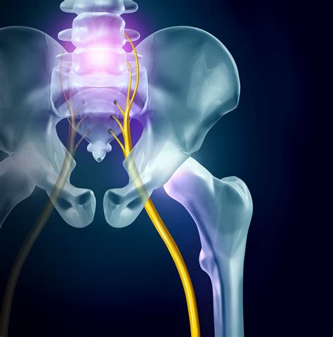 Unlocking The Mystery Of Sciatica Understanding Symptoms Causes And