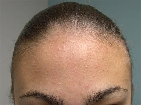 How To Get Rid Of Clogged Pores On The Forehead Skincareaddicts