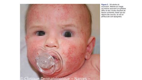Dermatologie Pediatrique Cours 2 Dermatite Atopique Youtube