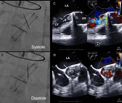 Cine Fluoroscopy Of The Prosthetic Aortic Valve And Transoesophageal