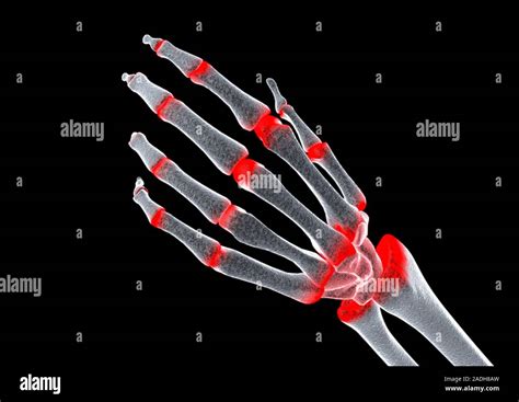Arthritic Hand Computer Artwork The Finger And Wrist Joints Are