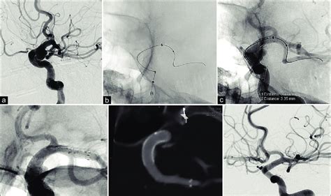 A Left Internal Carotid Artery Angiogram Shows A Supraclinoid