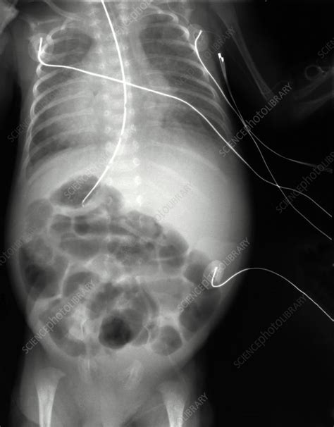 X Ray Of Swollen Abdomen Stock Image M3301463 Science Photo Library