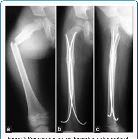 Figure 1 From Intramedullary Nailing Compared With Spica Casts For Isolated Femoral Fractures In