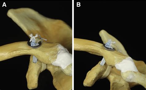 Figure 2 From Arthroscopic Coracoclavicular Ligament Reconstruction Of