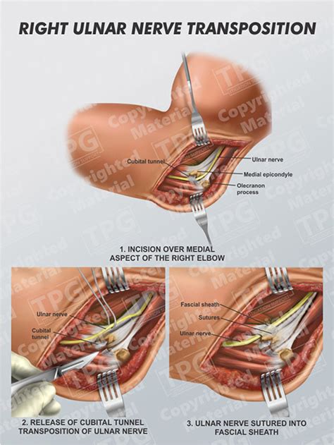 Left Ulnar Nerve Transposition And Medial Epicondylectomy 60 Off