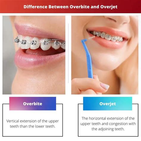 Overbite Vs Overjet Difference And Comparison