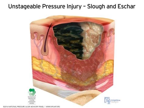 Npte 2019 Changes Integumentary Pressure Injury Classifications