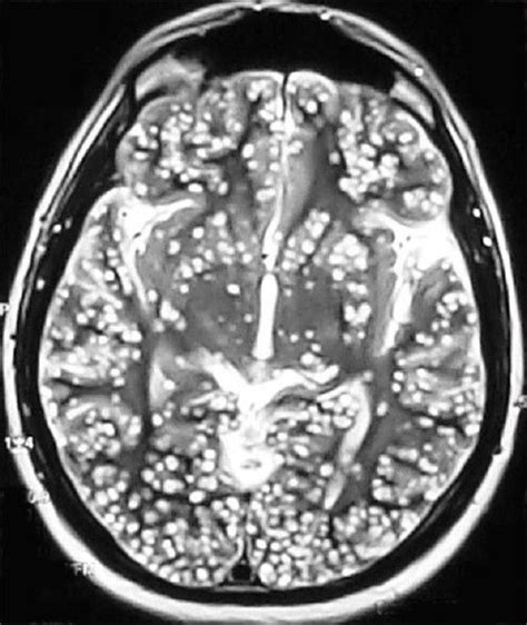 What Are White Spots On Mri Brain Scan Mri Scan Machine Images And
