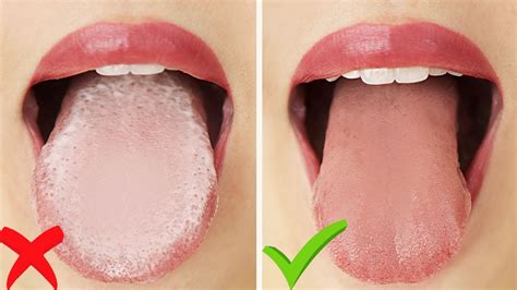 How To Get Rid Of Plaque On The Tongue News Dentagama