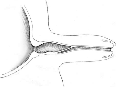 Figure 6 From The Anatomy And Embryology Of Posterior Urethral Valves Semantic Scholar