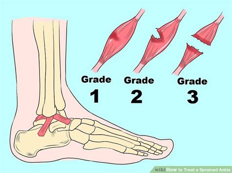 Grade 3 Ankle Sprain Recovery Exercises Exercisewalls