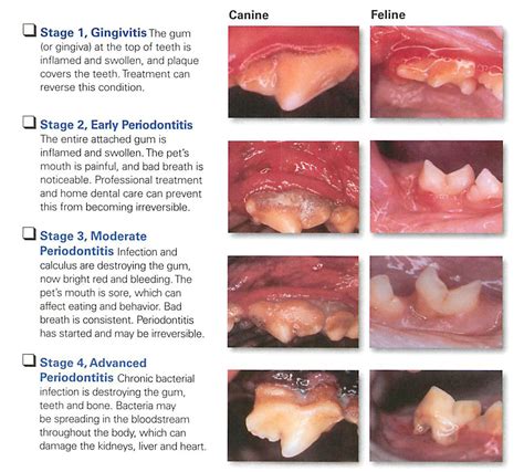 Heres What You Need To Know About The Stages Of Periodontal Disease