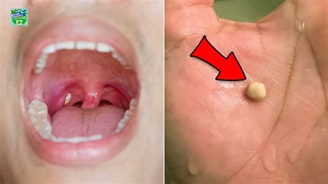 2 Best Home Remedies For Tonsil Stones That Work Fast Youtube