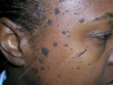 Dermatosis Papulosa Nigra Stock Image C0592780 Science Photo Library