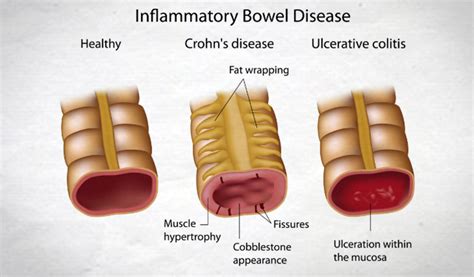 Inflammatory Bowel Disease Ibd Crohns And Colitis