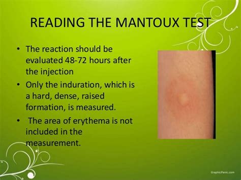 The Mantoux Test