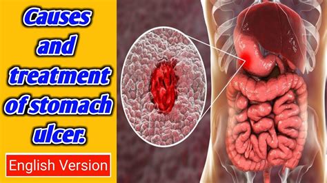 Causes And Treatment Of Stomach Ulcer Stomach Ulcer Video Ulcer Symptoms In English Youtube